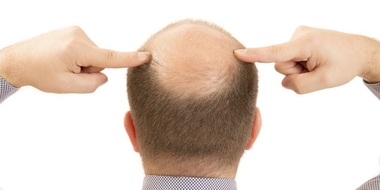 La alopecia hereditaria afecta a un 40% de los hombres de entre 18 y 39 años